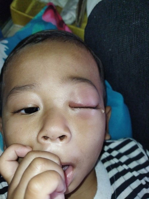 Glaukoma atau katarak