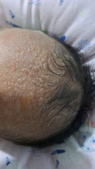 Bruntusan pada bayi new born