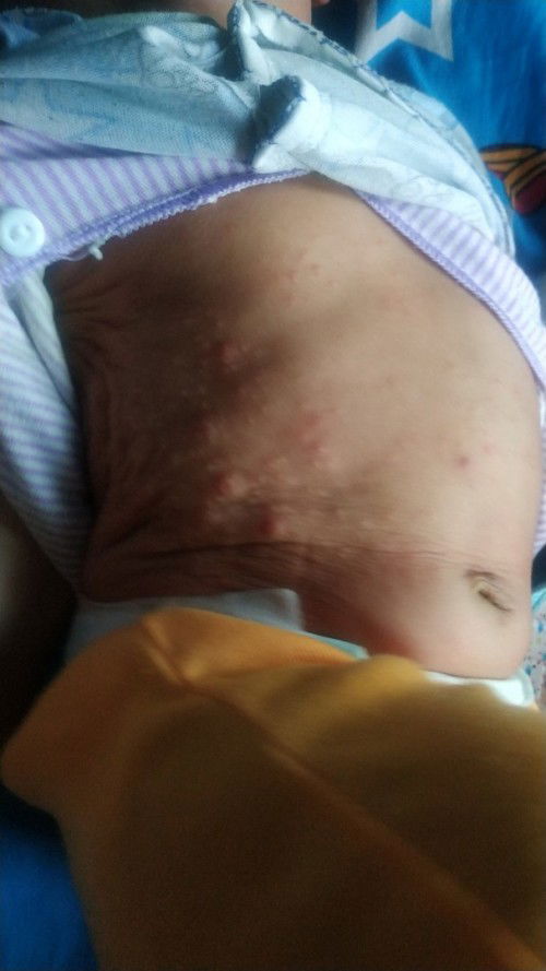 Anak terkena scabies, obatnya apa