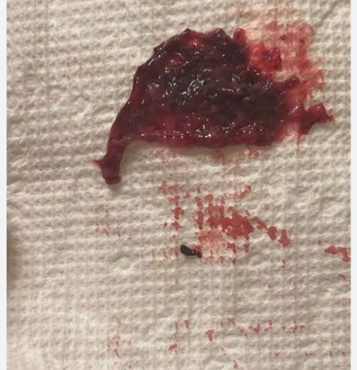 Helo po...ask lang po sana ako sino nakatry makunan dto Ng 7 weeks po.....niraspa po ba kau...kasi a