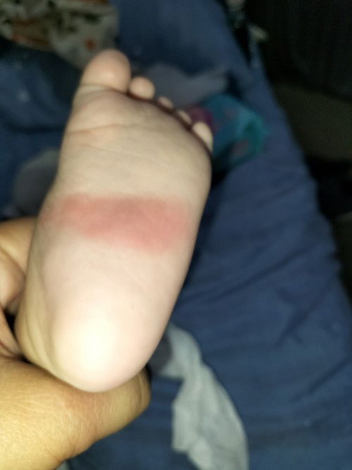 ask ko lang sana kung may idea kayo sa red marks sa paa ni baby?
