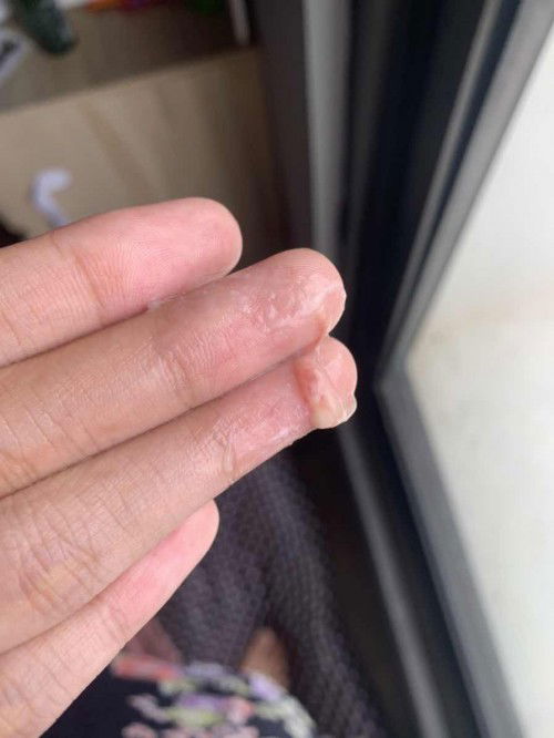 Keputihan disertai seperti ada fleknya