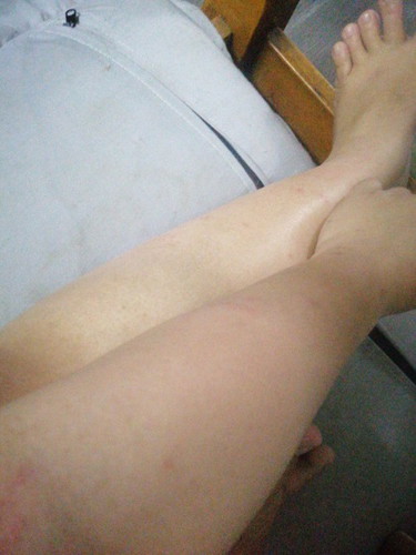 Ubat gatal2