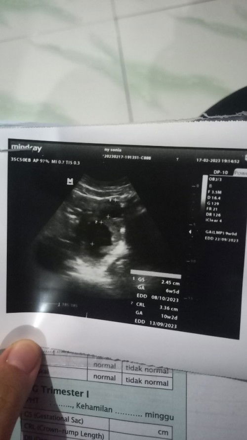 Uk 8w di usg Kantung rahim kembar tapi ukurannya beda dan belum terlihat janinnya bhya ga sih bun??