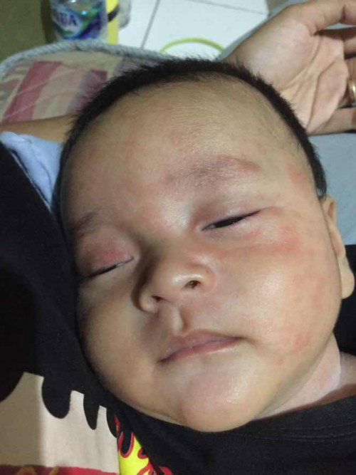 kulit baby sensitif