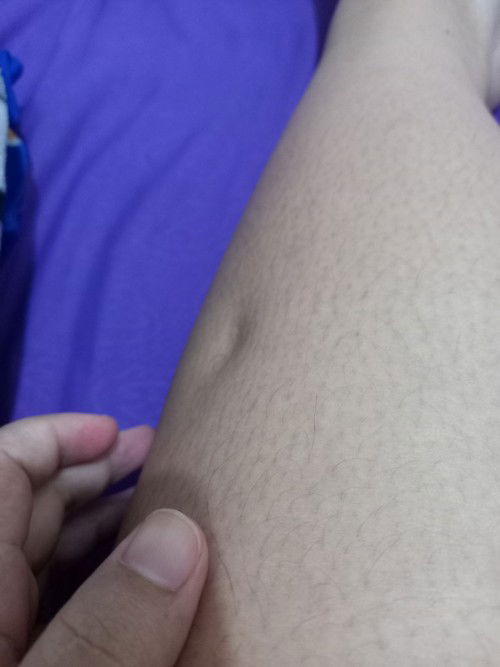 Betis bengkak, kalau ditekan jdi condong kedalam