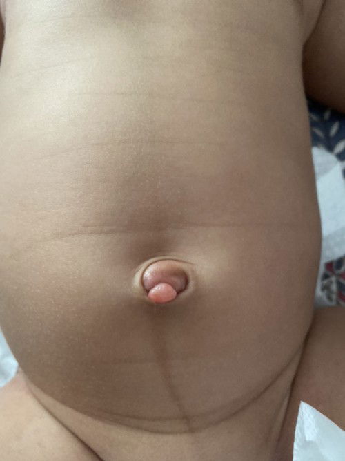 Pusat tersembul! Help!