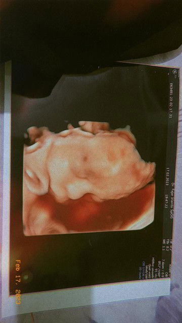 Masyaallah 25wek berat 880 jenis kelamin laki laki bun semoga semoga sehat sehat ya buu