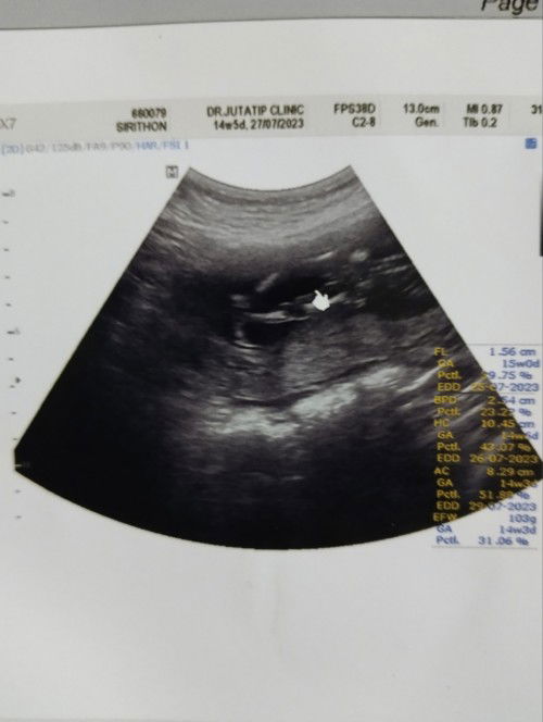 อยากสอบถามแม่ๆค่ะหมอบอกว่าได้ผู้หญิง 80% ค่ะอยากให้แม่ๆช่วยดูว่าหญิงหรือชายค่ะ แม่แอบลุ้นผู้หญิงค่ะ