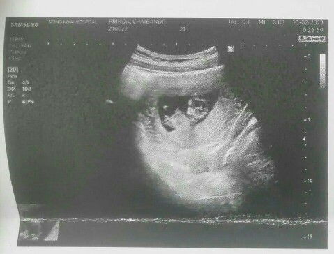 ขอดูภาพอัลตราซาวด์ 10-11W ของแม่ๆหน่อยจ้า