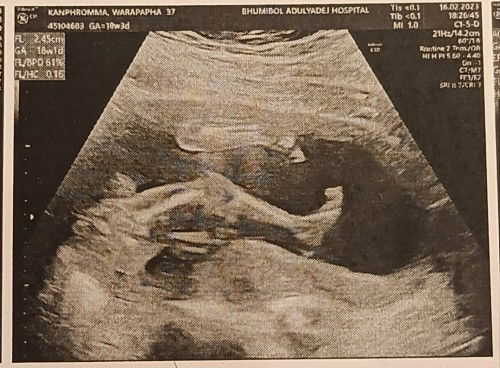 18W3D เพศไหนในฟิล์มอัลตร้าซาว