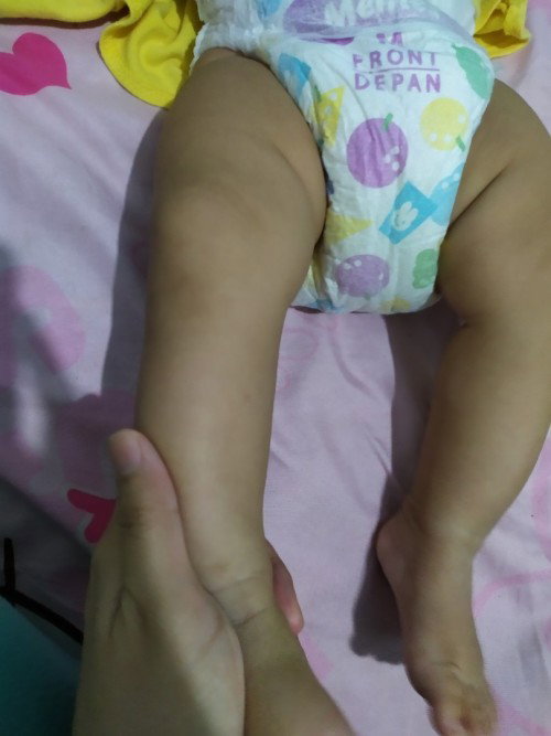 betis bayi bengkok