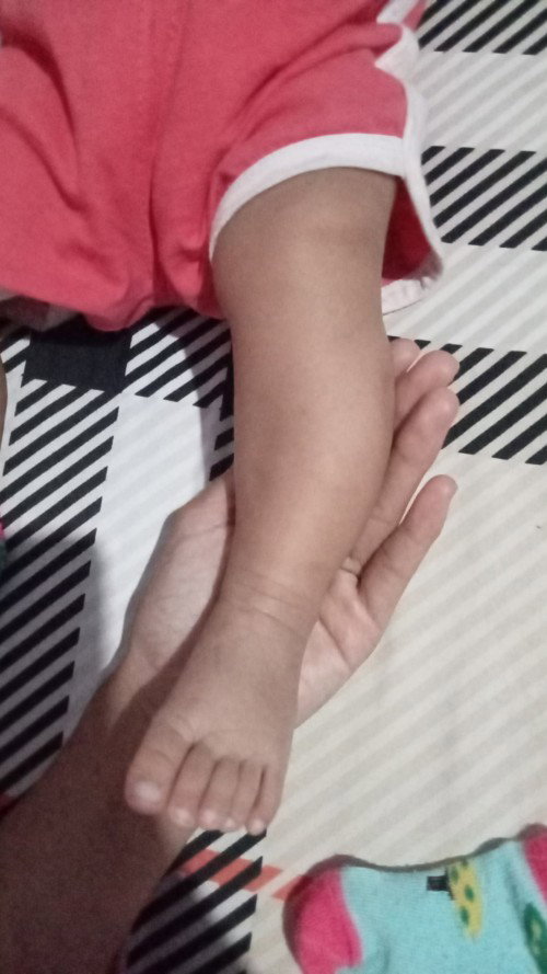 Kaki bengkok atau ctev