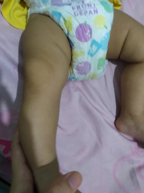 kaki bayi 4 bulan bengkok