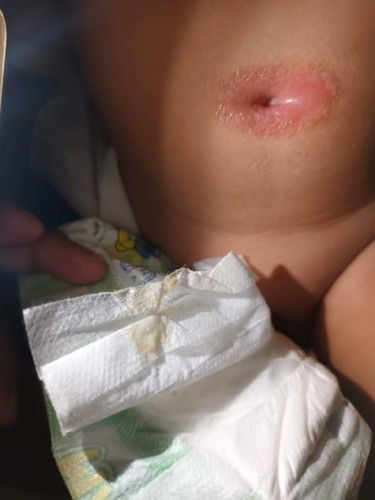 UMBILICAL CORD