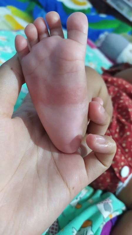 Kaki bayi merah