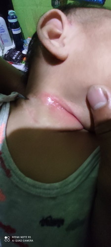 Rash in neck folds