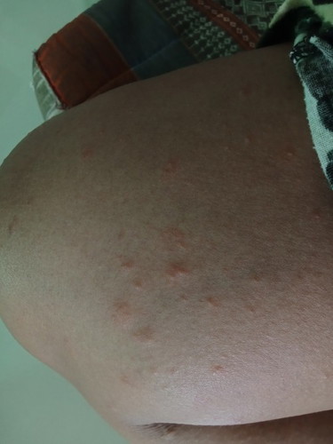 ขึ้นผื่นคัน