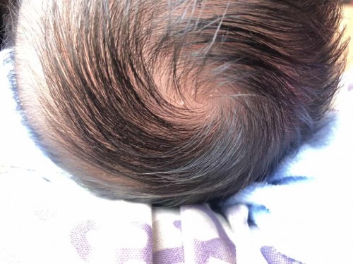 ตุ่มเม็ดบนหัวลูก