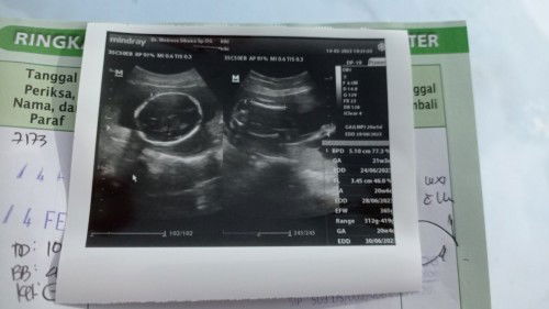 Bun mau tanya,, pas usia khmilan 20w 5d kmrin bru USG