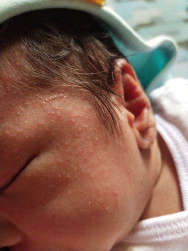 Momshies normal ba sa baby Yung parang my mga tigyawat na maliliit sa Mukha nya? Going 1month plng