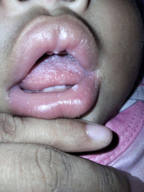 Jamur/sariawan pada lidah bayi