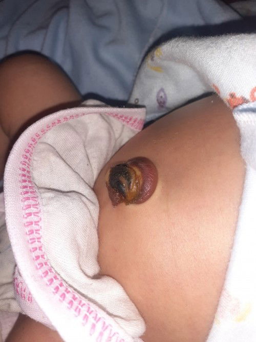 perawatan tali pusar