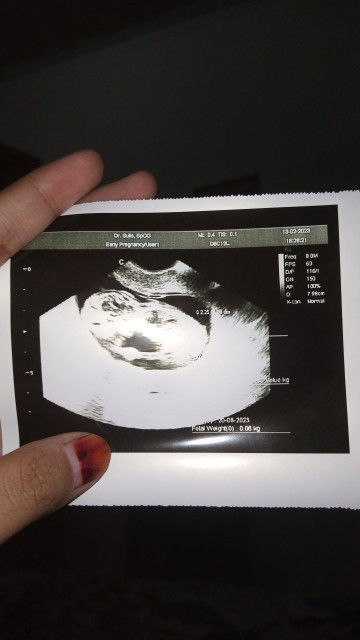 Usia 13 minggu perkembangan janin