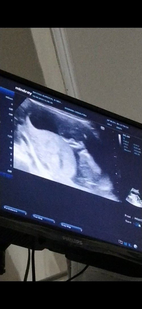 Tanong lang po with regards uterine muscle contraction at 16 weeks.