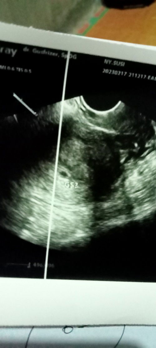 USG usia kandungan 6 minggu