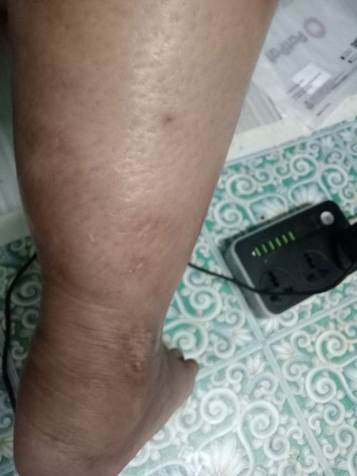 Siapa pernah jadi Mcm nie kandungan 34 week cecair keluar melalui betis