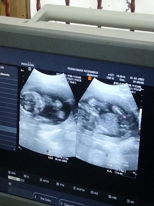 Berat janin dan jenis kelamin.