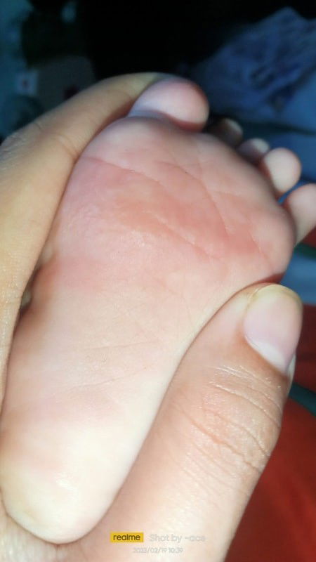 Butol sa paa ni baby