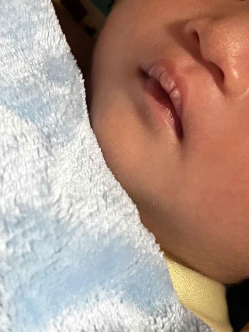 Bibur bayi pecah2 dan putih