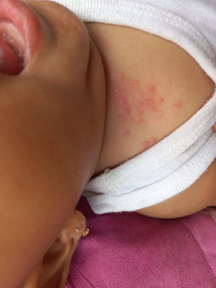 Kulit sekitar leher merah merah kenpa ya bun? Bisa di obati apa ya bun? Bantu sharing