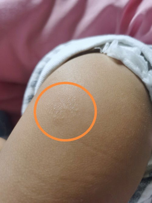 Dry skin na kumakalat