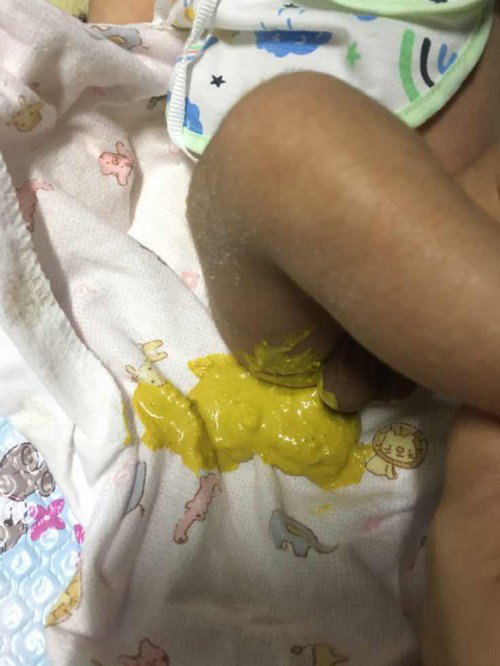สอบถามเรื่องอึของลูก
