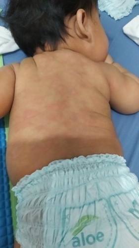 Mga momsh,naka experience po ba kayo ng ganito sa baby nyo? Nagkadry skin tapos spot spot sa likod