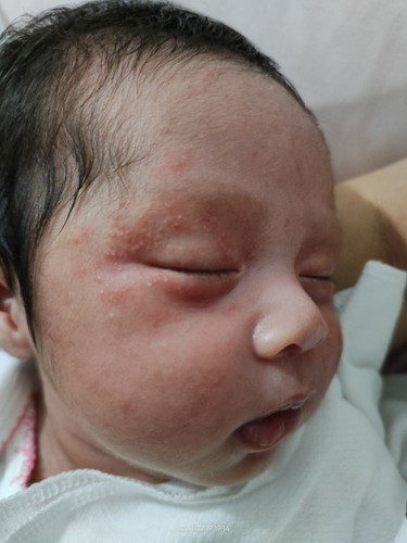 RASHES on new born babies