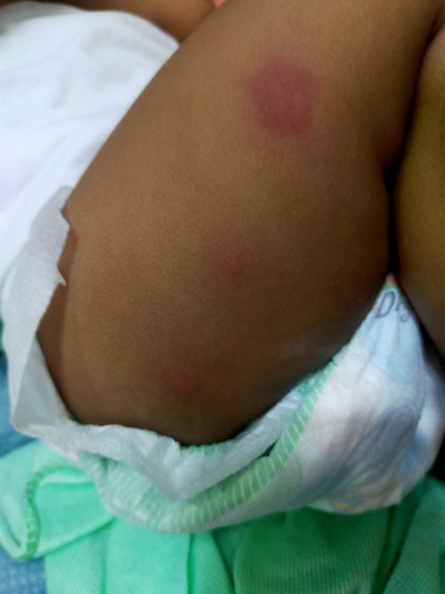Pantal sa skin ni baby 6mons old baby