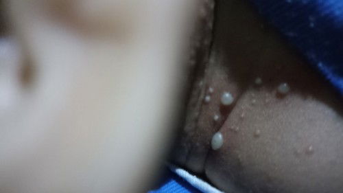 Ruam merah disertai nanah