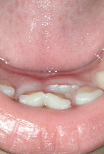 Gigi bayi belum tanggal tp sudah tumbuh gigi