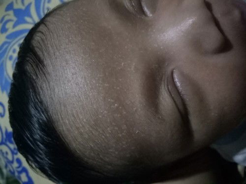 Bun anak saya muncul sprti itu dikening sampe kulit kepla juga
Cara ngilnginnya gmna ya, bun?