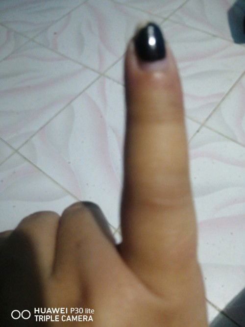 Hello mga momshie, meron pong kumagat sakin na insekto. Dko lang alam kung anong yun. Sobrang sakit,