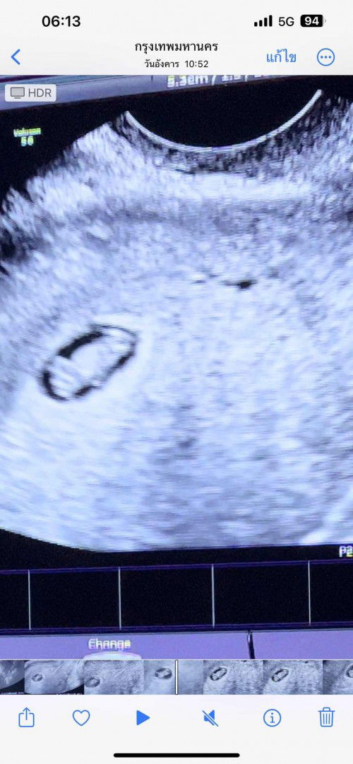 อุลตร้าซาวด์ วันที่ 14 ก.พ 66 น้องหัวใจยังเต้นปกติ  พอมาอุลตร้าซาวด์ วันที่ 18 ก.พ 66 หมอบอกน้องหัวใจไม่เต้นแล้ว 😭😭
