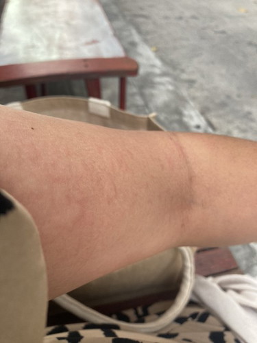 แม่บ้านไหนเป็นผื่นคันบ้างค่ะ