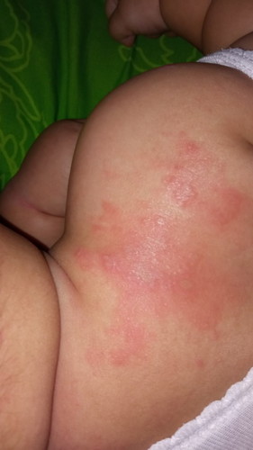 Kulit bayi merah seprti melepuh tengah nya