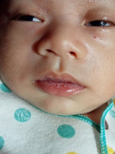 Bibir dan lidah bayi bercak putih umur 1 bulan