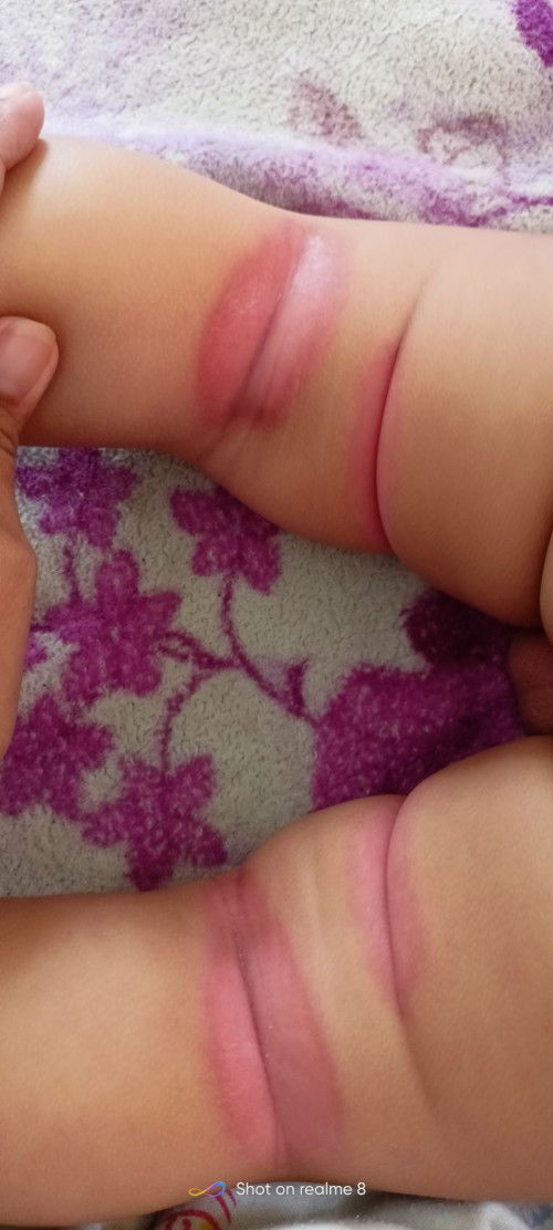 Rashes sa likod ng paa