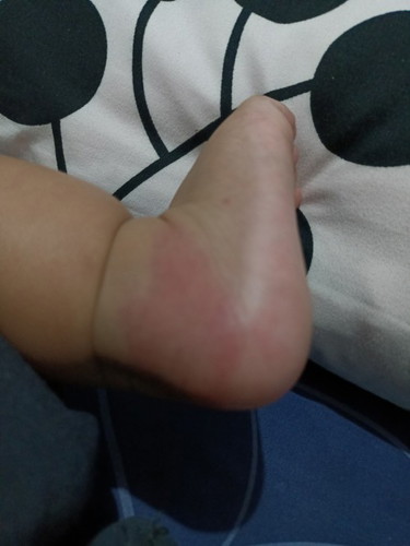 kagat ng insekto o balat?